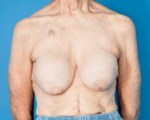 a Capsular Contracture patient