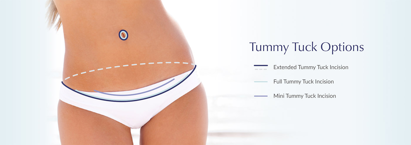 Diagram of tummy tuck surgery options