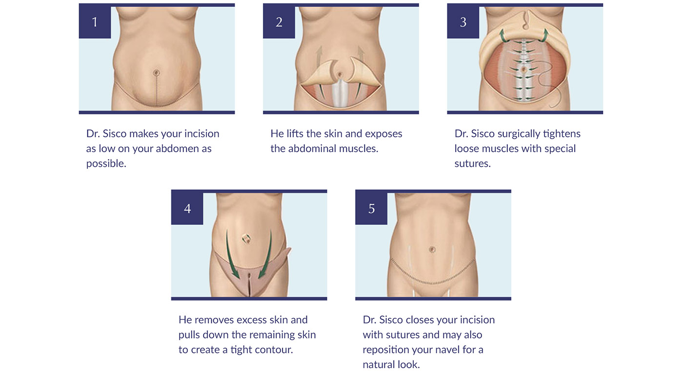 Diagram tummy tuck surgery steps