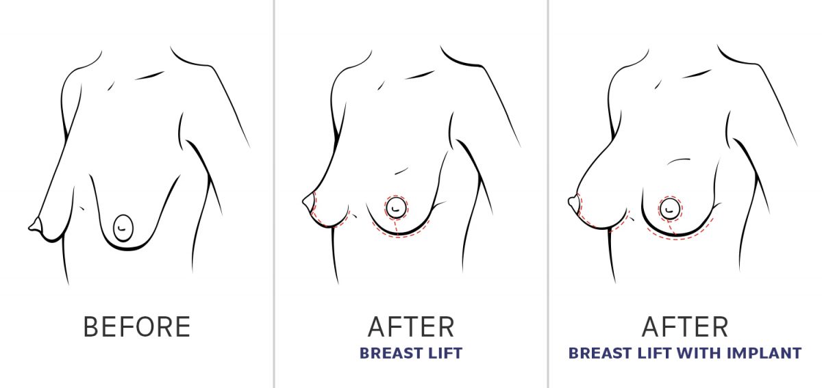 Breast before, after and after with implant illustration