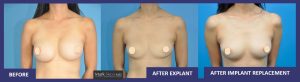 Before Explant, After Explant, Implant Exchange