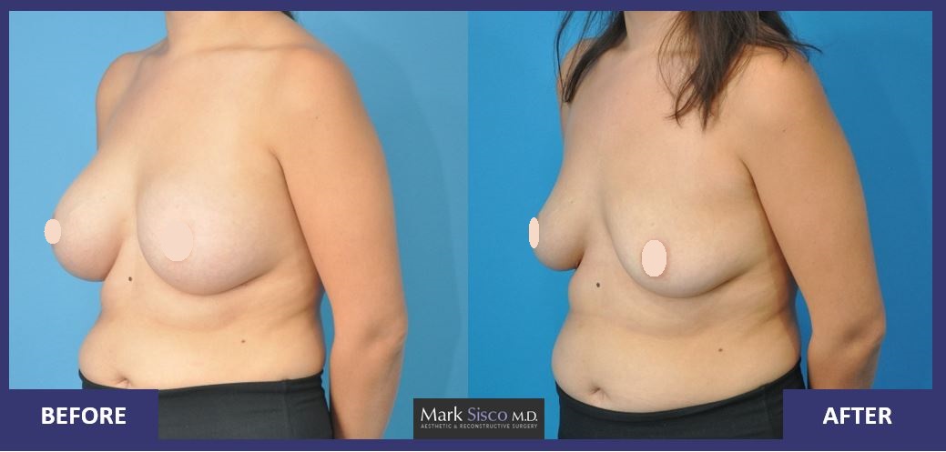 Ex 1 - Explant of medium size implant in larger breast, good elasticity
