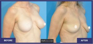 Ex 2 - Explant of medium size implant in smaller breast, minimal drooping