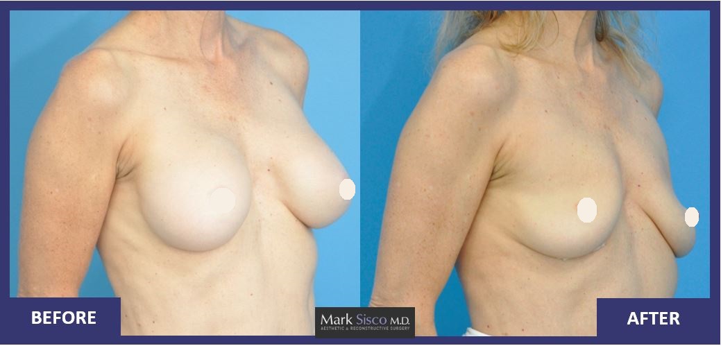 Ex 2 - Explant of medium size implant in smaller breast, minimal drooping