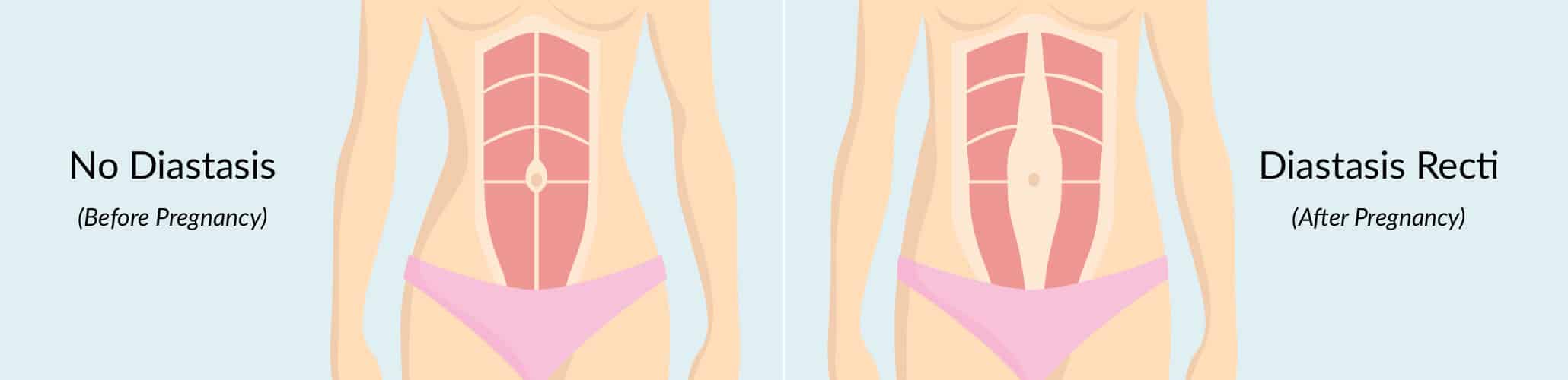 1744070225 diastasis