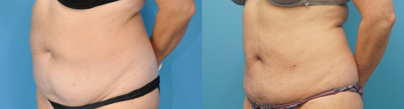 Before & After Abdominoplasty/Tummy Tuck Case 279 Front View in North Shore, IL