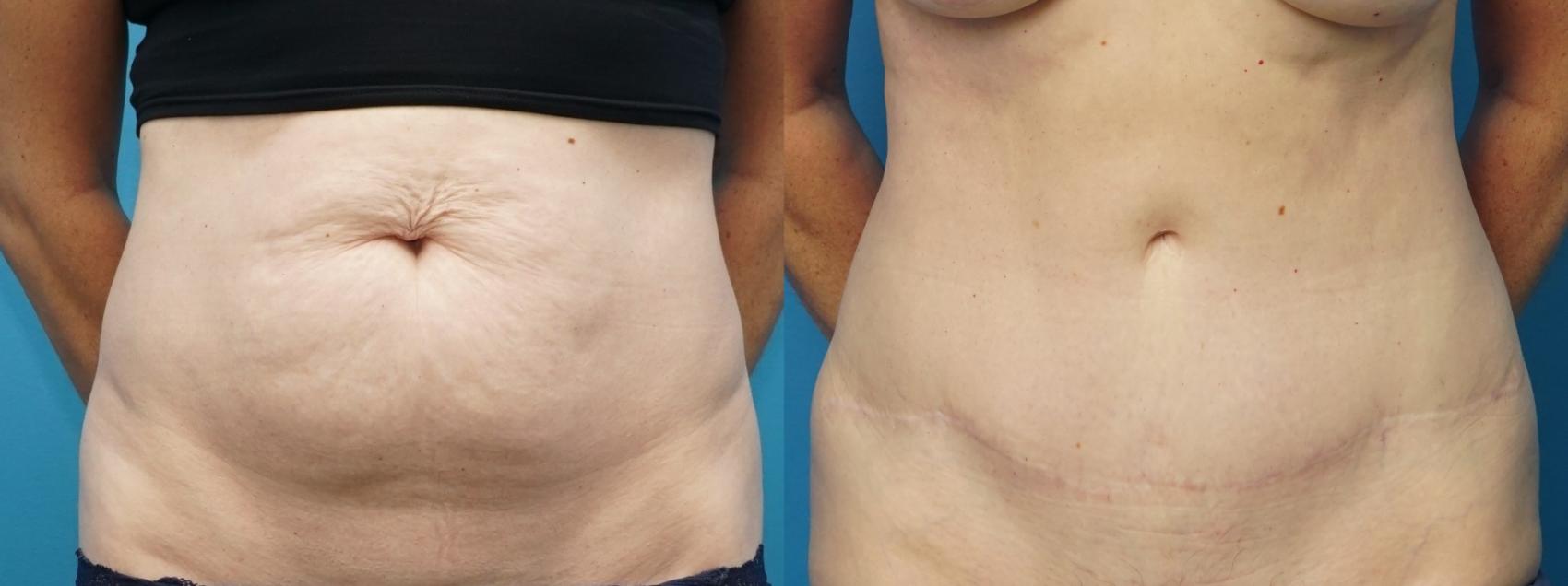Before & After Abdominoplasty/Tummy Tuck Case 377 Front View in North Shore, IL