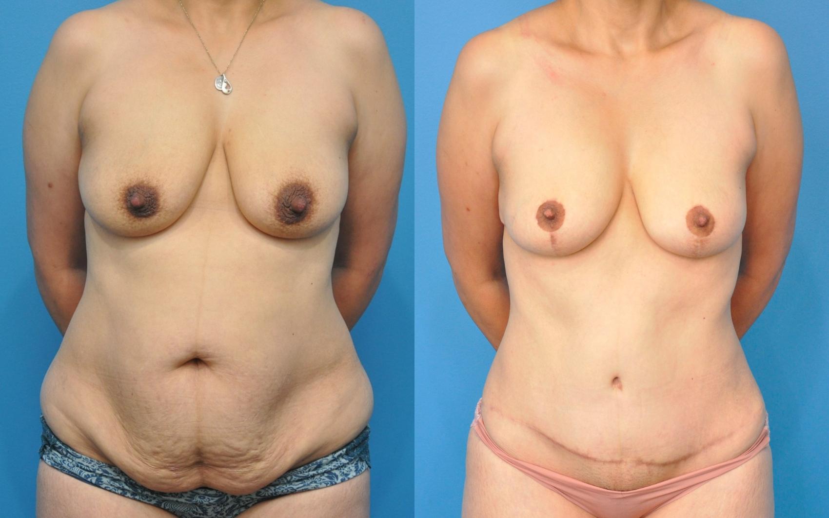 Before & After Abdominoplasty/Tummy Tuck Case 222 View #1 View in North Shore, IL