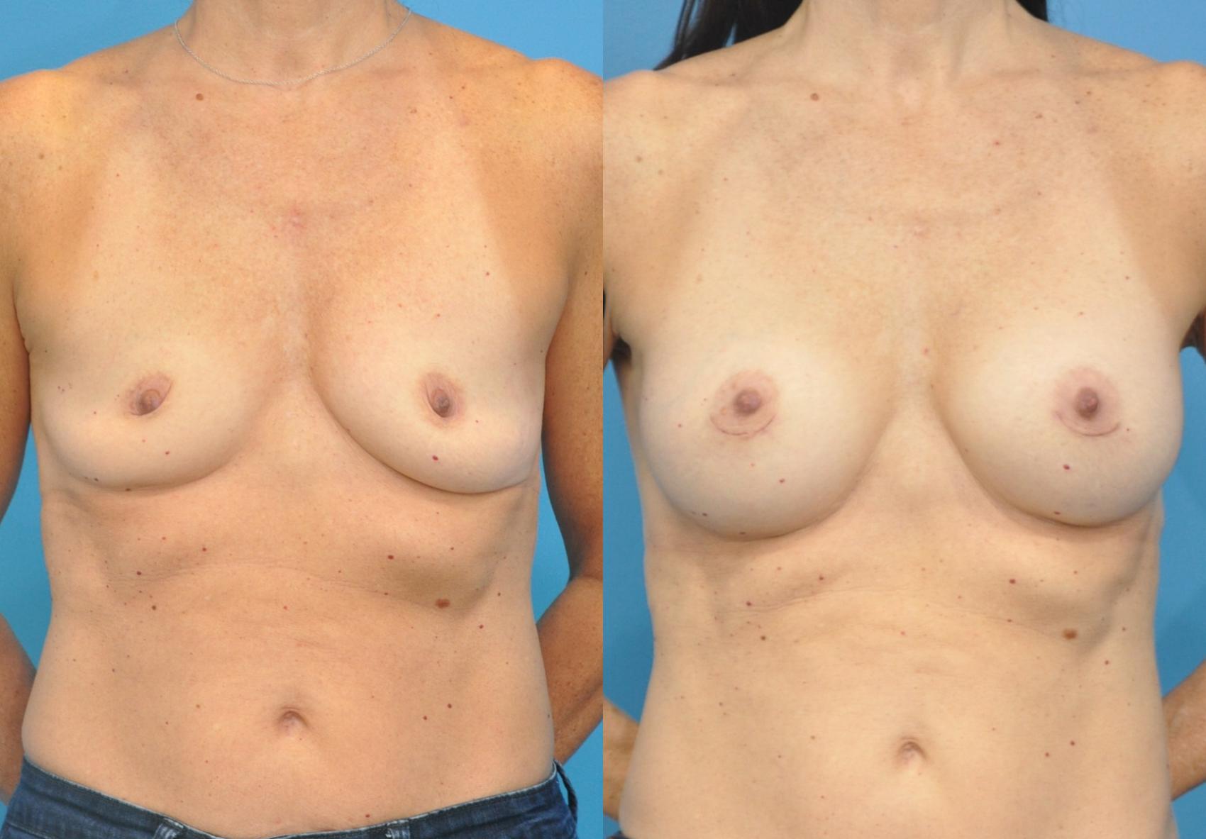 Before & After Breast Augmentation Case 86 View #1 View in North Shore, IL