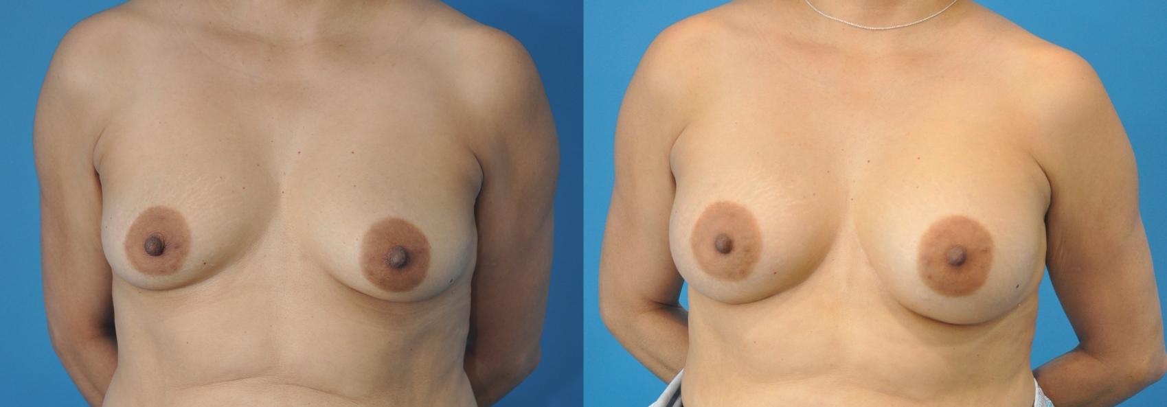 Before & After Breast Augmentation Case 135 View #1 View in North Shore, IL