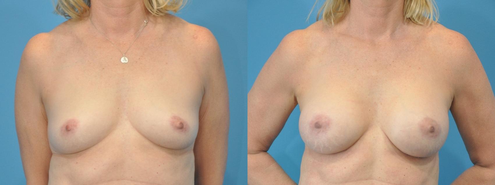 Before & After Breast Augmentation Case 115 View #1 View in North Shore, IL