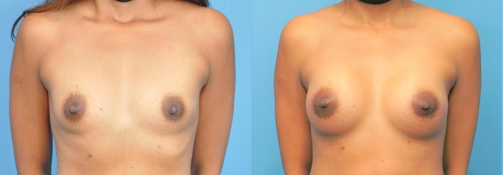 Before & After Breast Augmentation Case 252 View #1 View in North Shore, IL
