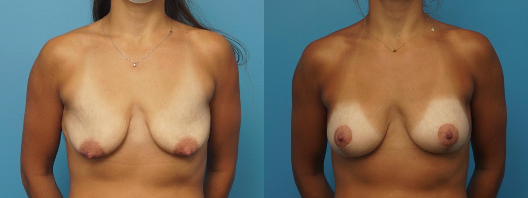 Before & After Breast Augmentation Case 399 Front View in North Shore, IL