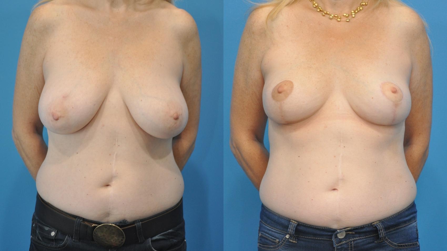 Before & After Breast Lift (Mastopexy) Case 338 Front View in North Shore, IL