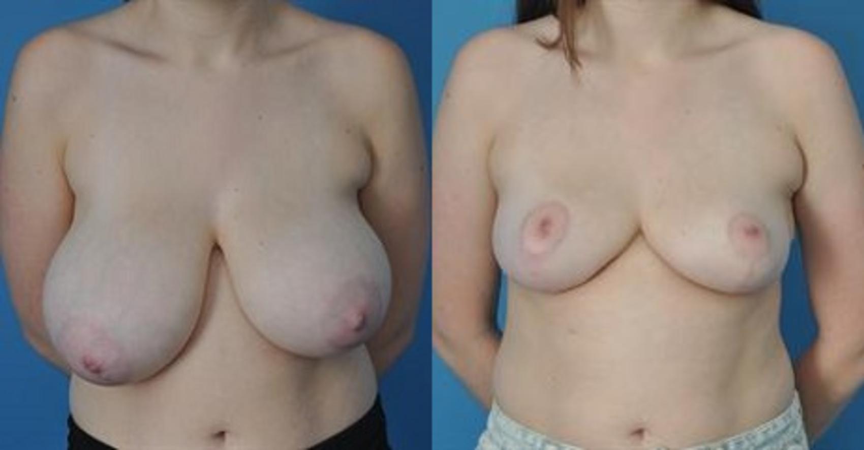 Before & After Breast Lift (Mastopexy) Case 18 View #1 View in North Shore, IL
