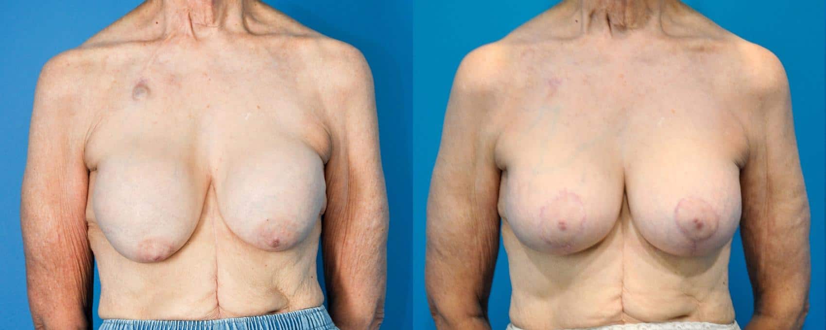 1744072298 breast lift mastopexy 11 view 1 detail