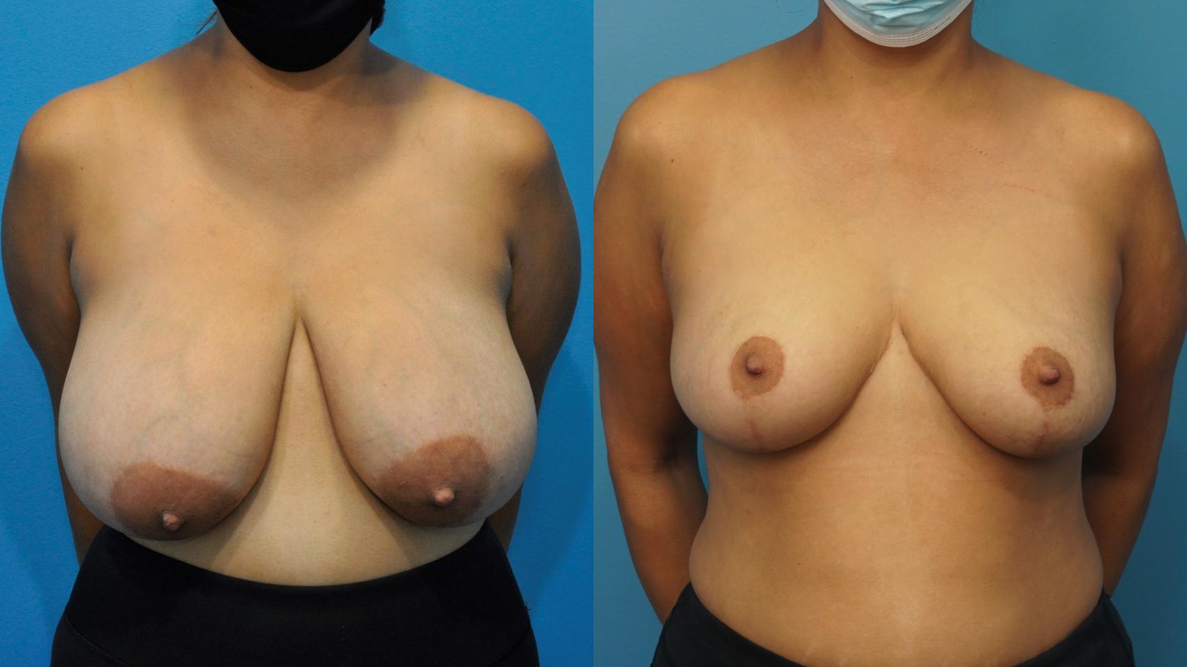Before & After Breast Reduction Case 360 Front View in North Shore, IL