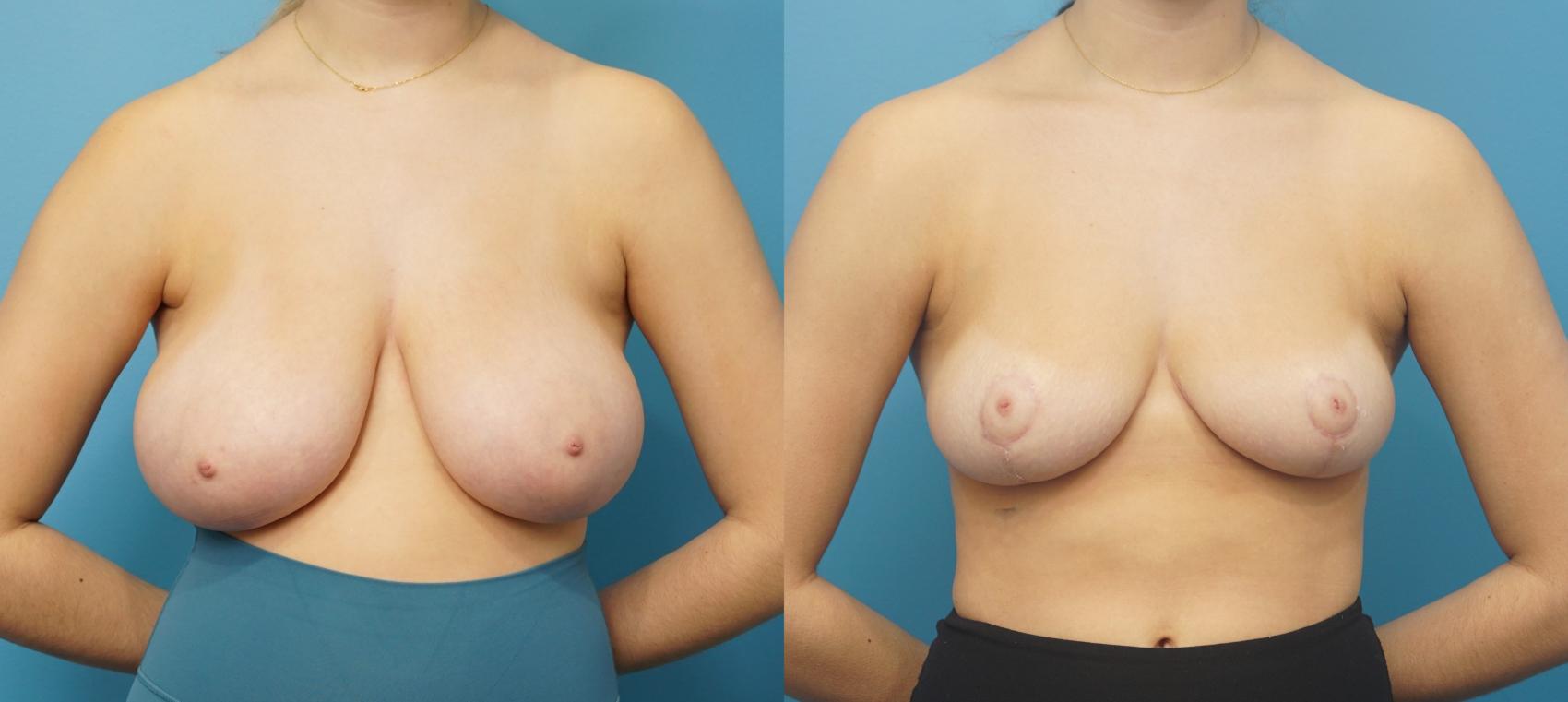 Before & After Breast Reduction Case 307 View #1 View in North Shore, IL