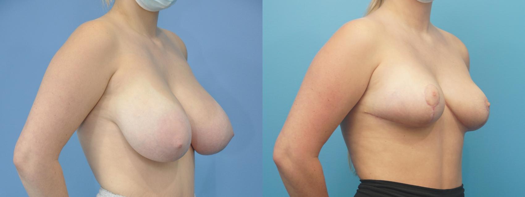 Before & After Breast Reduction Case 306 View #1 View in North Shore, IL