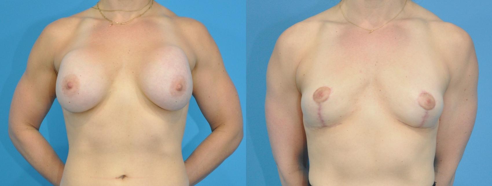 Before & After Breast Implant Removal Case 195 View #1 View in North Shore, IL