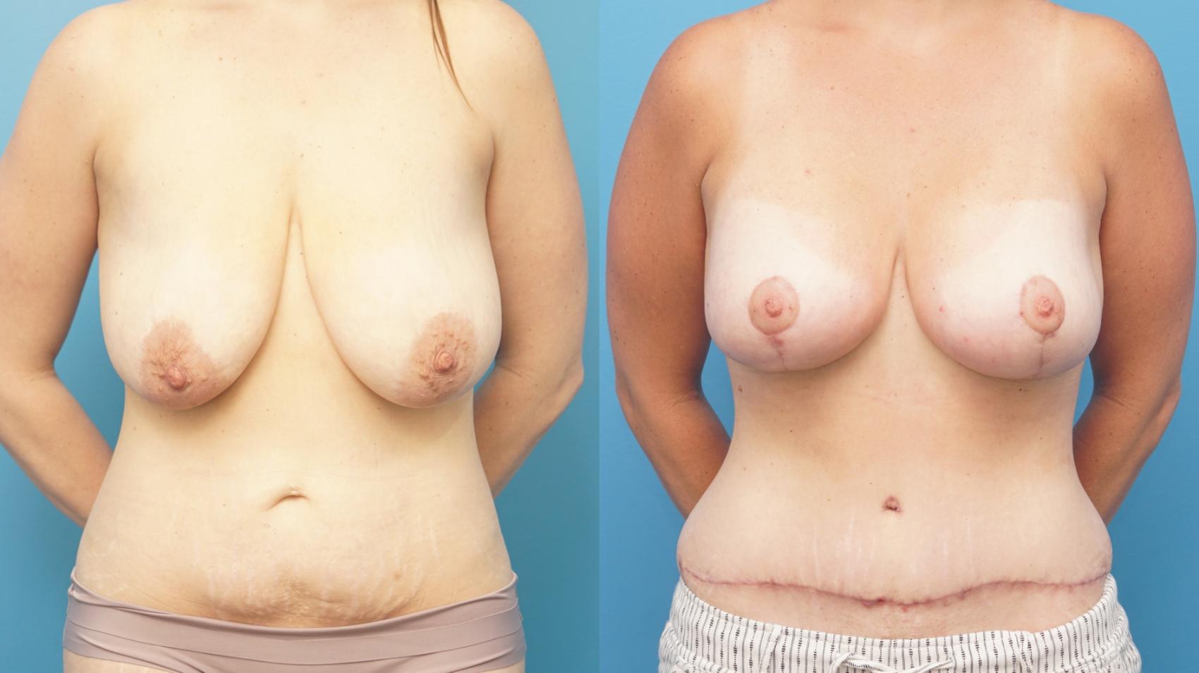 Before & After Abdominoplasty/Tummy Tuck Case 323 Front View in North Shore, IL