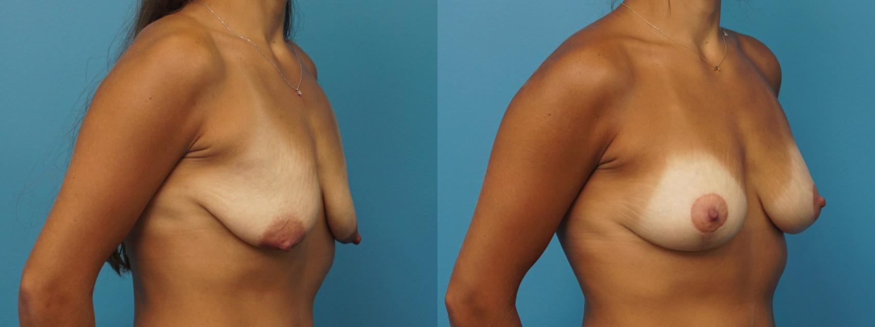 Before & After Breast Augmentation Case 399 Right Oblique View in North Shore, IL