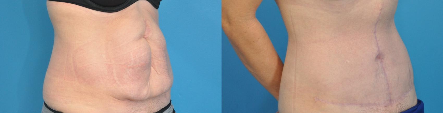 Before & After Abdominoplasty/Tummy Tuck Case 136 View #2 View in North Shore, IL