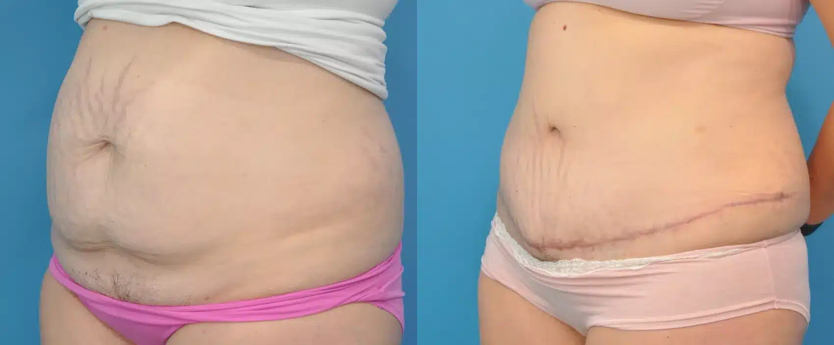 Before and After Image: Case #105 - left-front-oblique