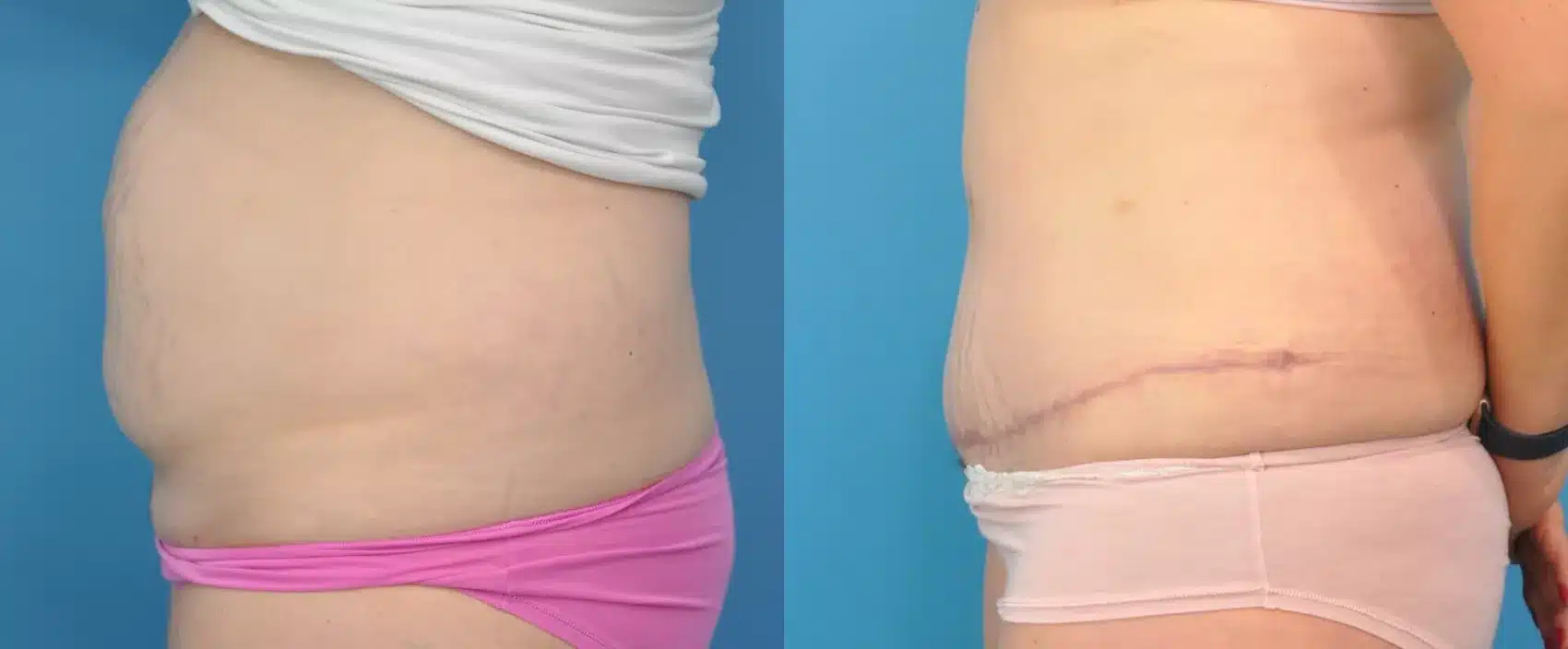 Before and After Image: Case #105 - left-side