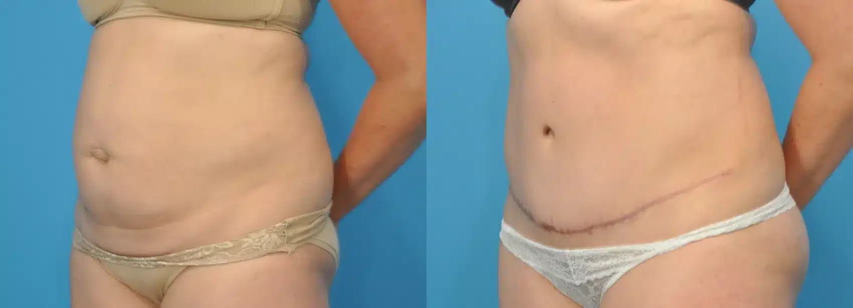 Before and After Image: Case #106 - left-front-oblique