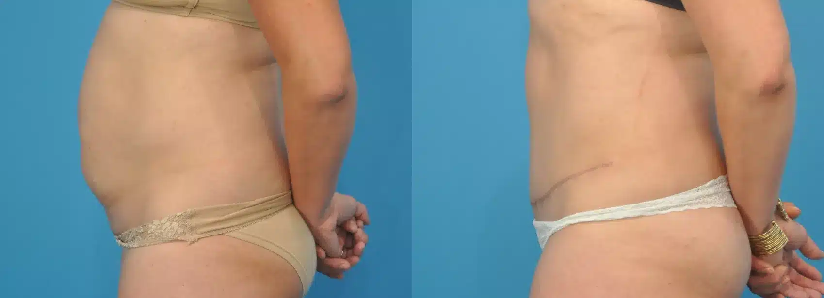 Before and After Image: Case #106 - left-side