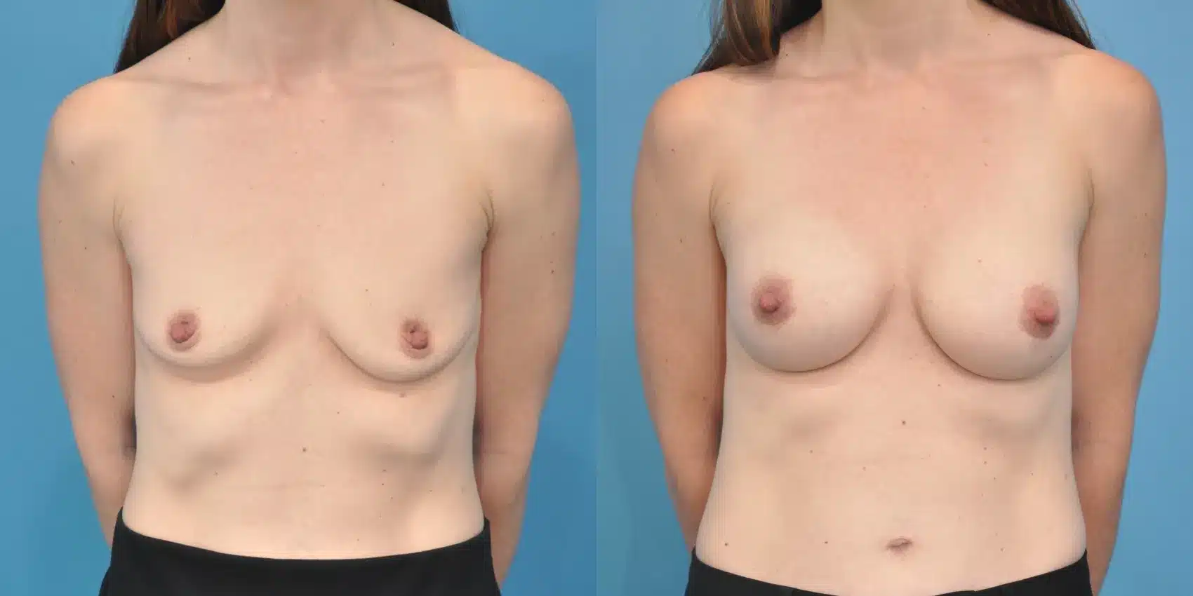 Before and After Image: Breast Augmentation 240 ml Silicone - front
