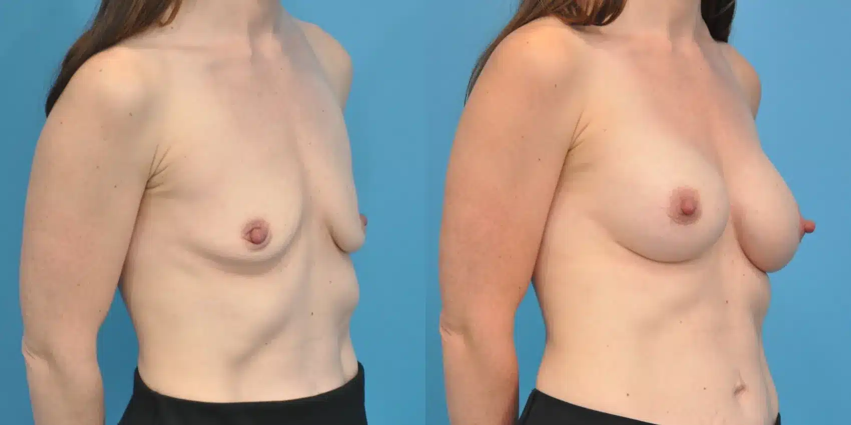 Before and After Image: Breast Augmentation 240 ml Silicone - right-front-oblique