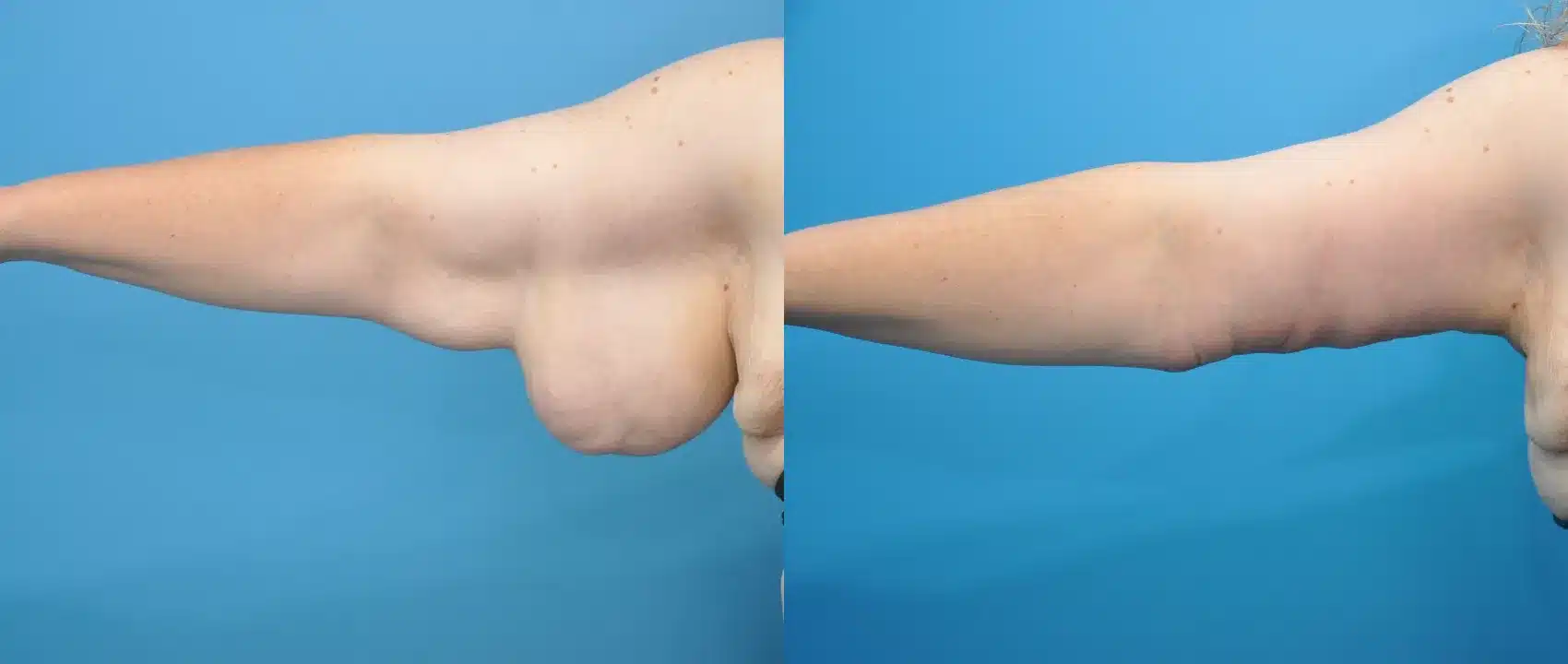 Before and After Image: Arm Lift - front