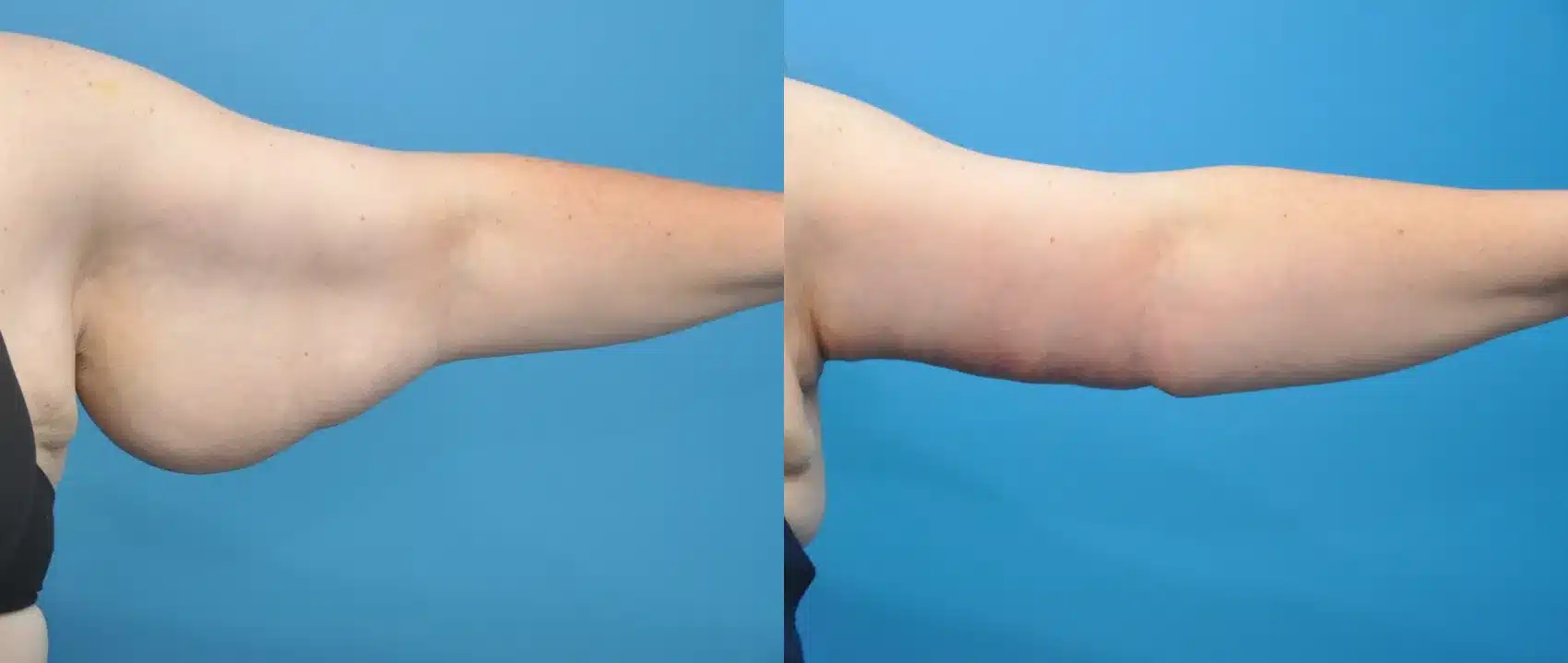 Before and After Image: Arm Lift - front