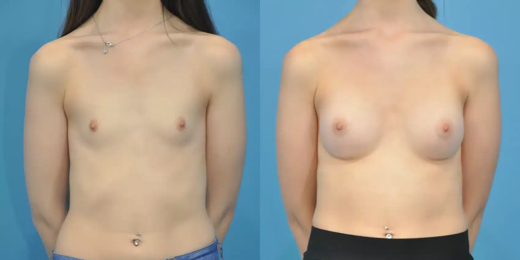 Before and After Image: Case #110 - front