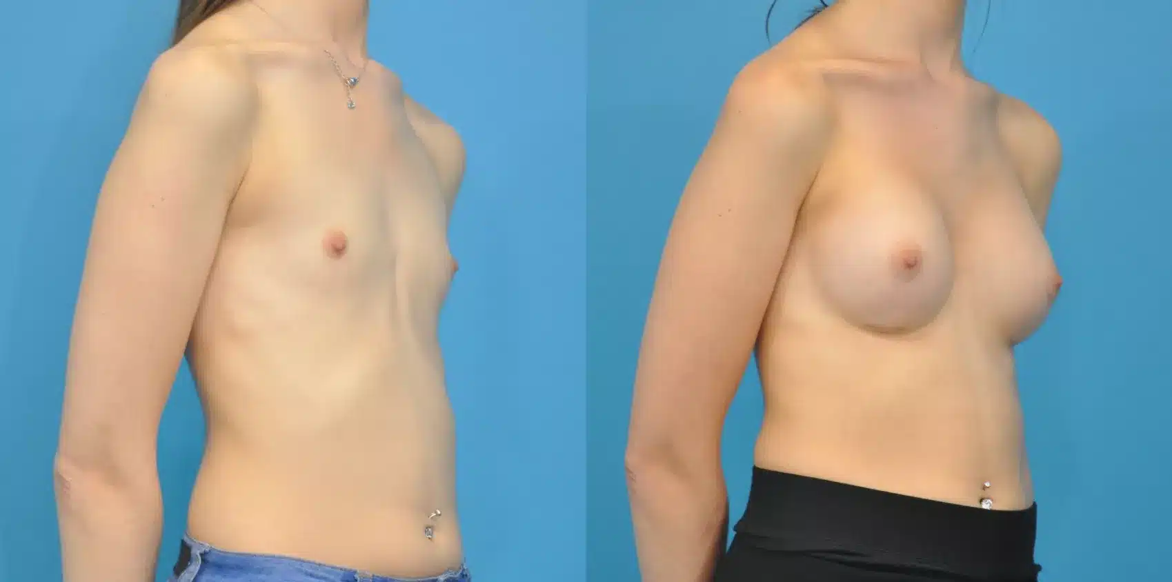 Before and After Image: Case #110 - right-front-oblique