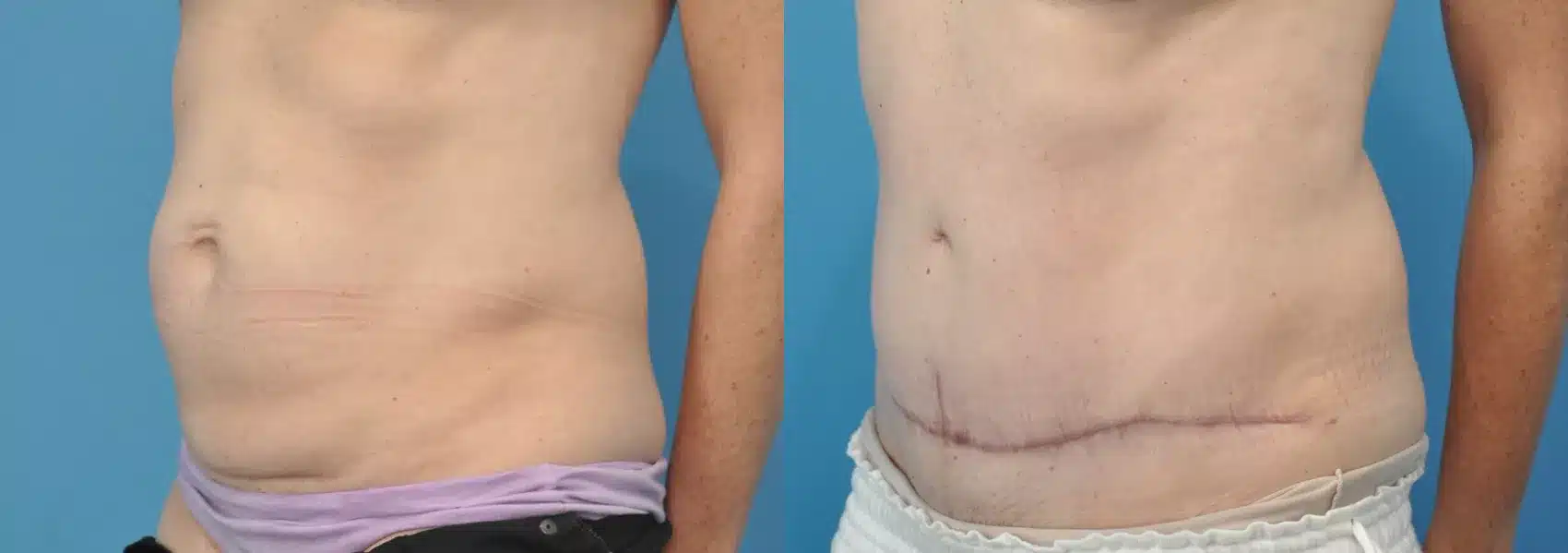 Before and After Image: Case #111 - left-front-oblique