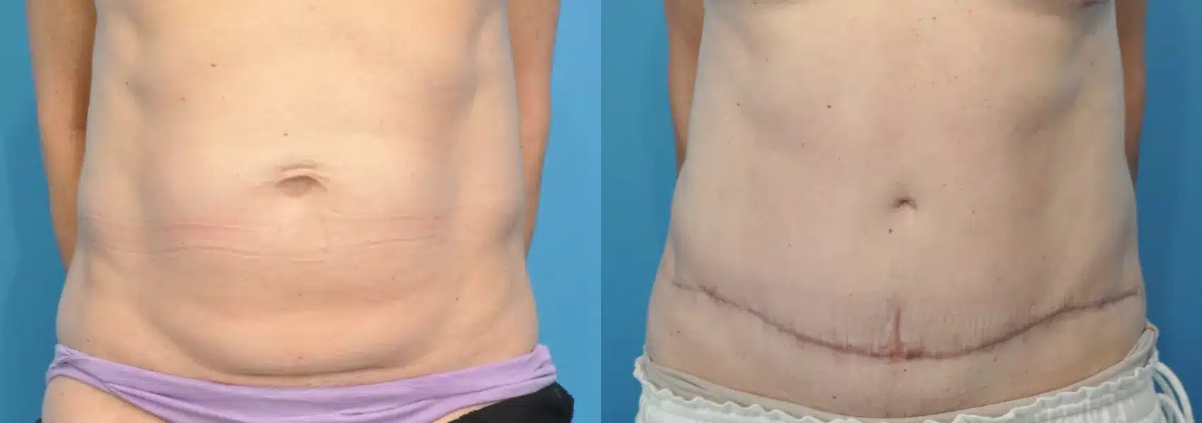 Before and After Image: Case #111 - front