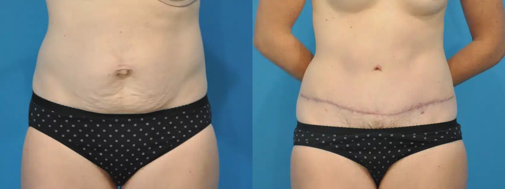 Before and After Image: Case #112 - front