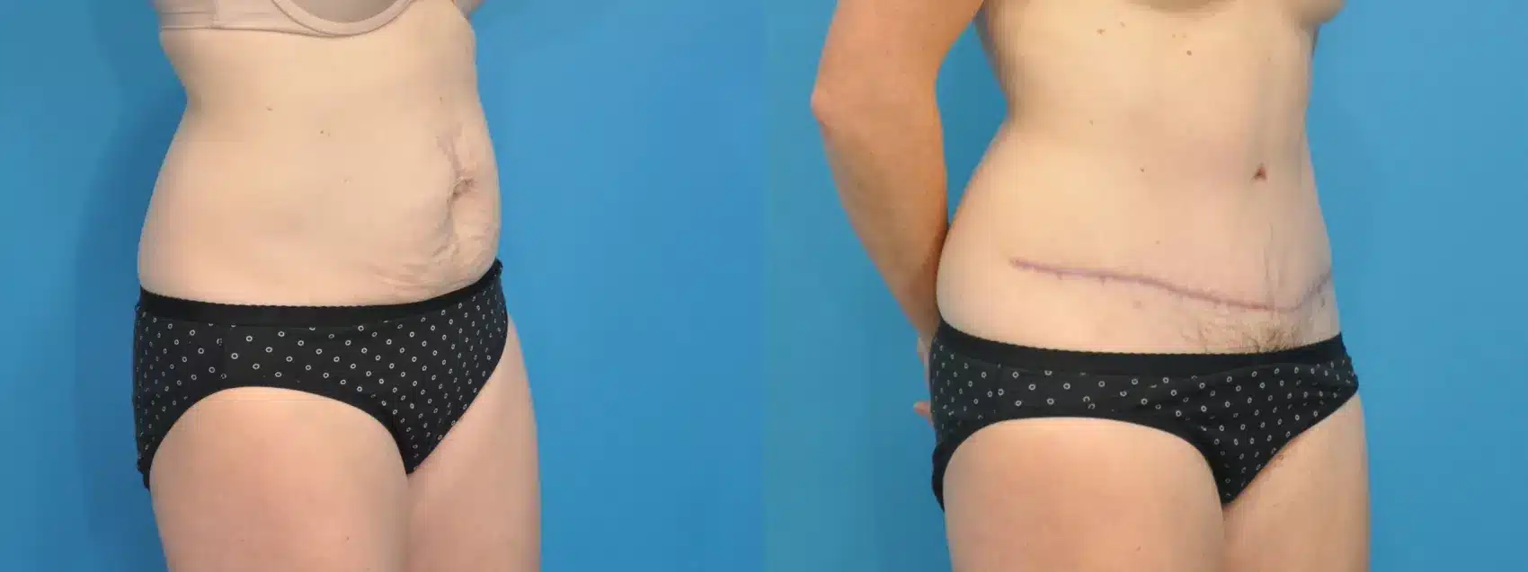 Before and After Image: Case #112 - right-front-oblique