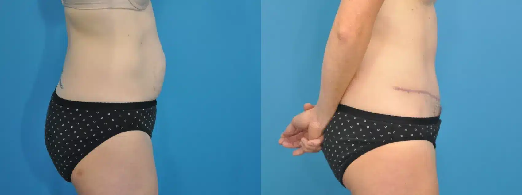 Before and After Image: Case #112 - right-side
