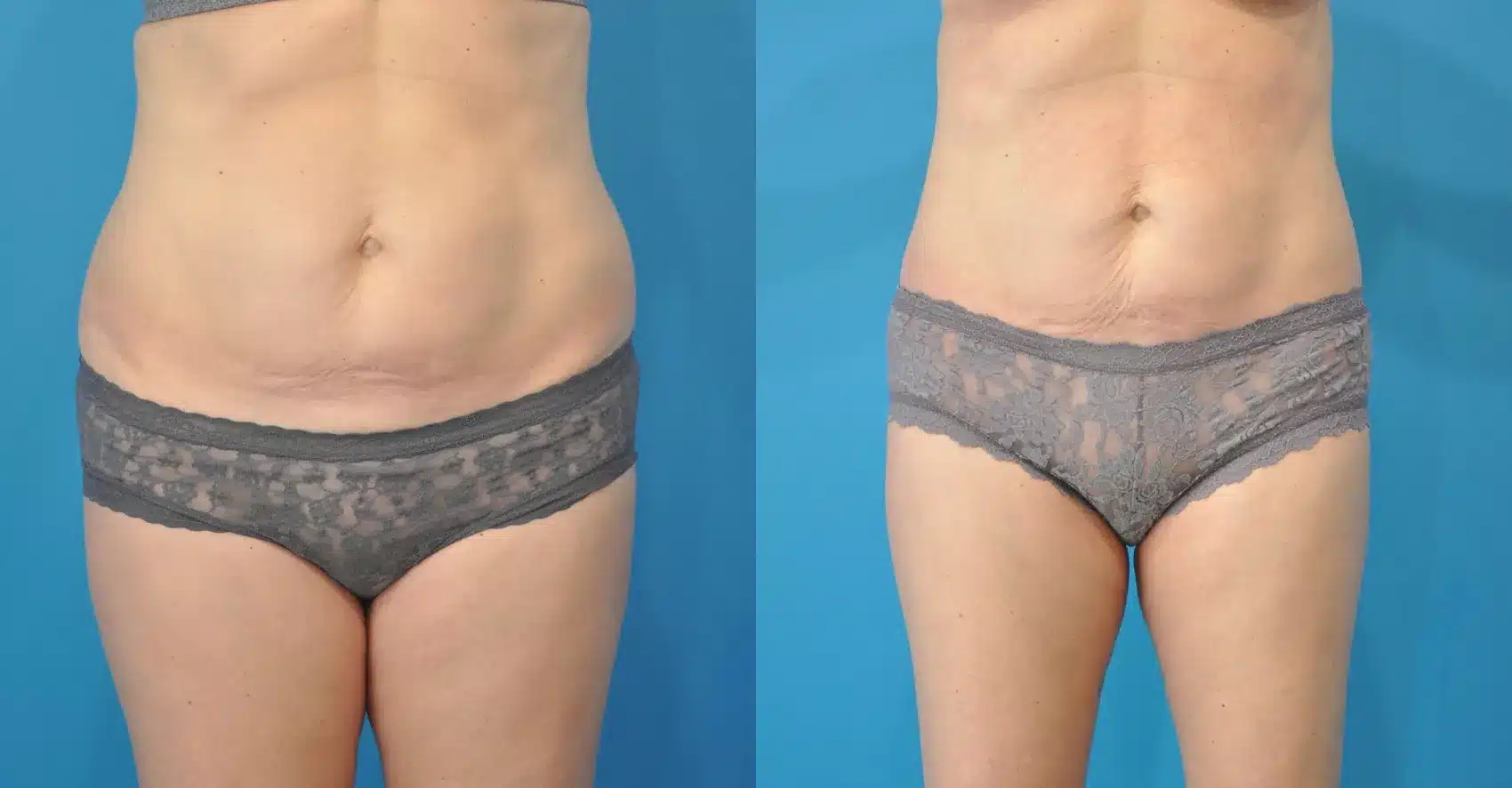 Before and After Image: Case #116 - front