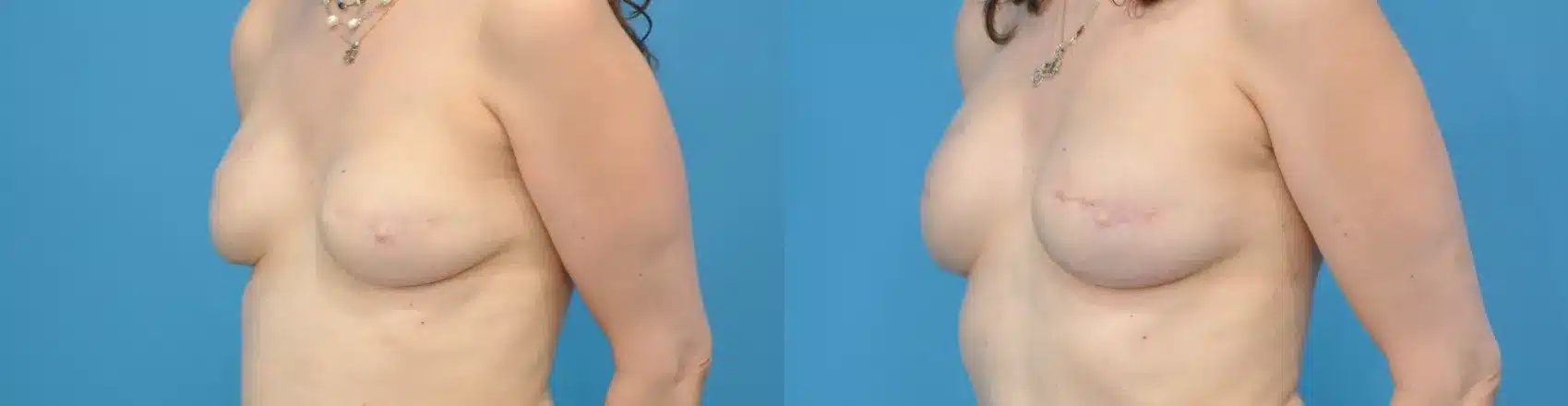 Before and After Image: Case #118 - left-front-oblique