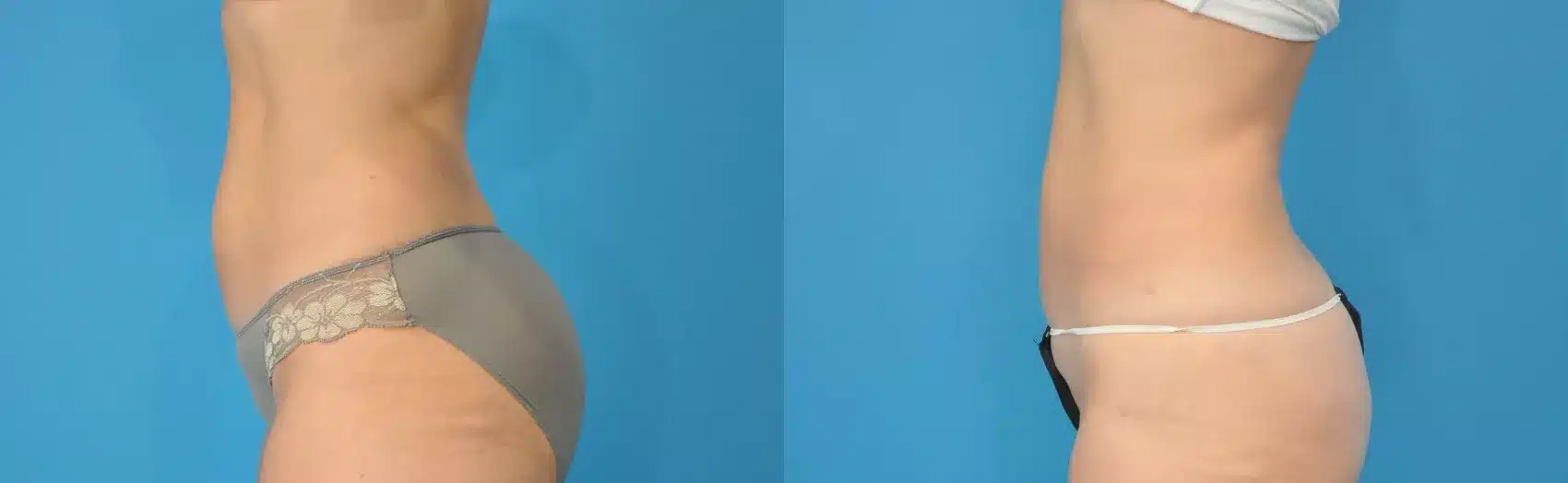 Before and After Image: Case 119 - left-side