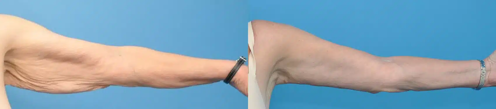 Before and After Image: Case #12 - front