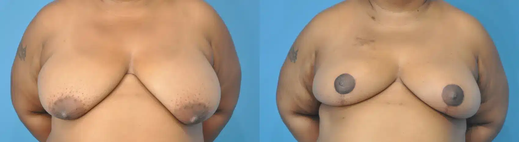 Before and After Image: Oncoplastic Reduction and Lift for Breast Cancer - front