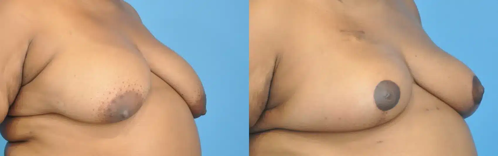 Before and After Image: Oncoplastic Reduction and Lift for Breast Cancer - right-front-oblique