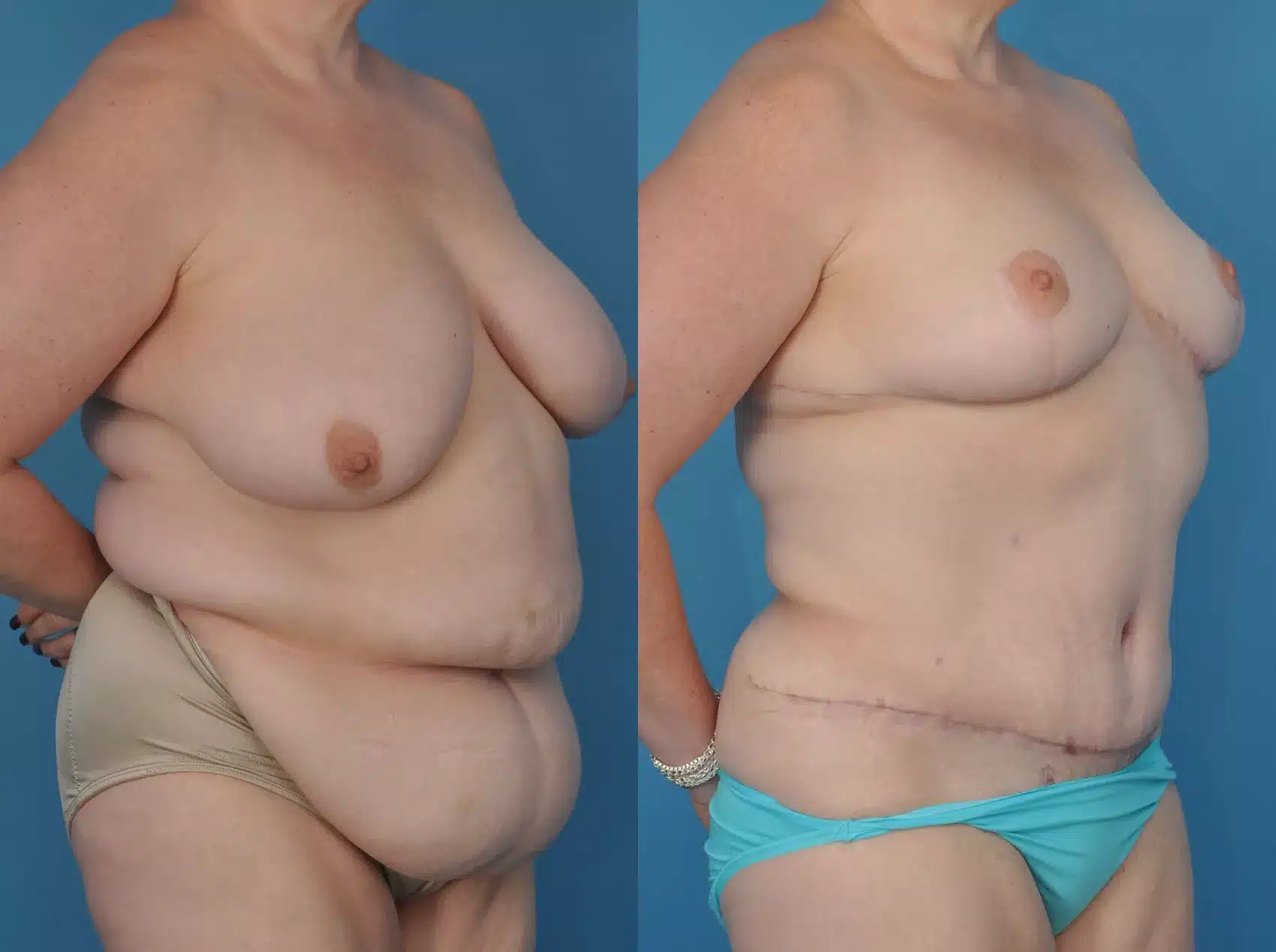 Before and After Image: Case #13 - right-front-oblique