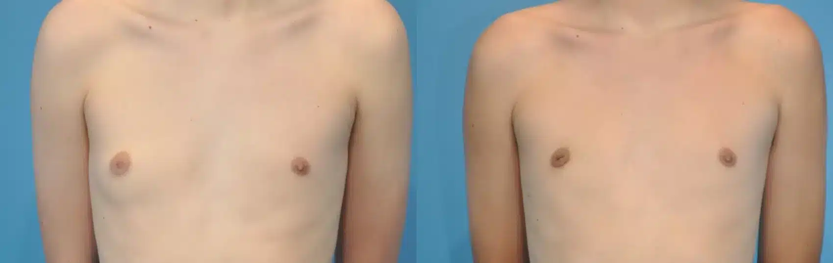 Before and After Image: Case #130 - front